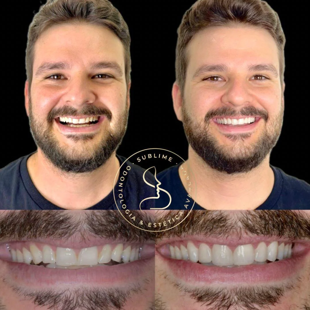 Facetas de resina