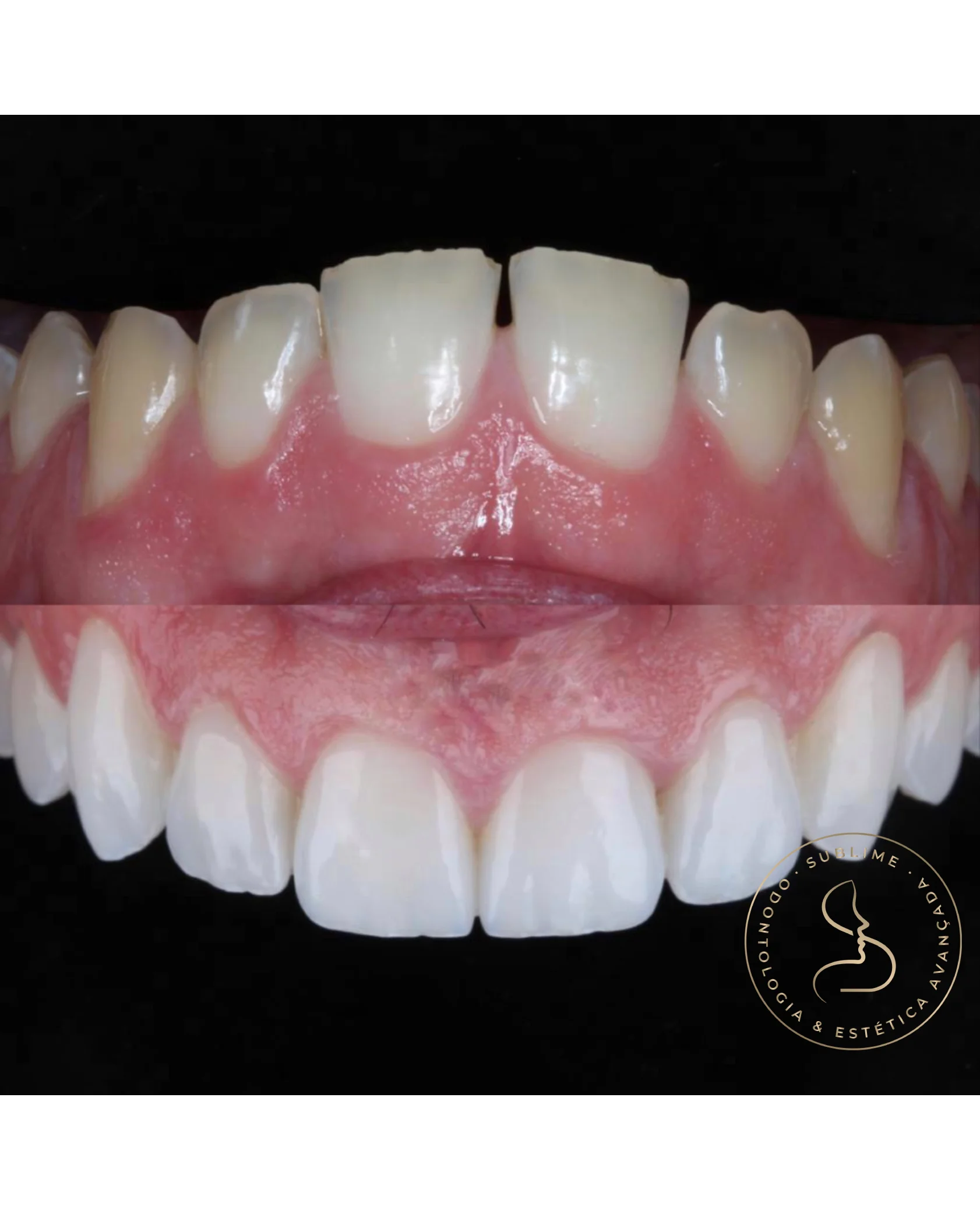 facetas porcelana