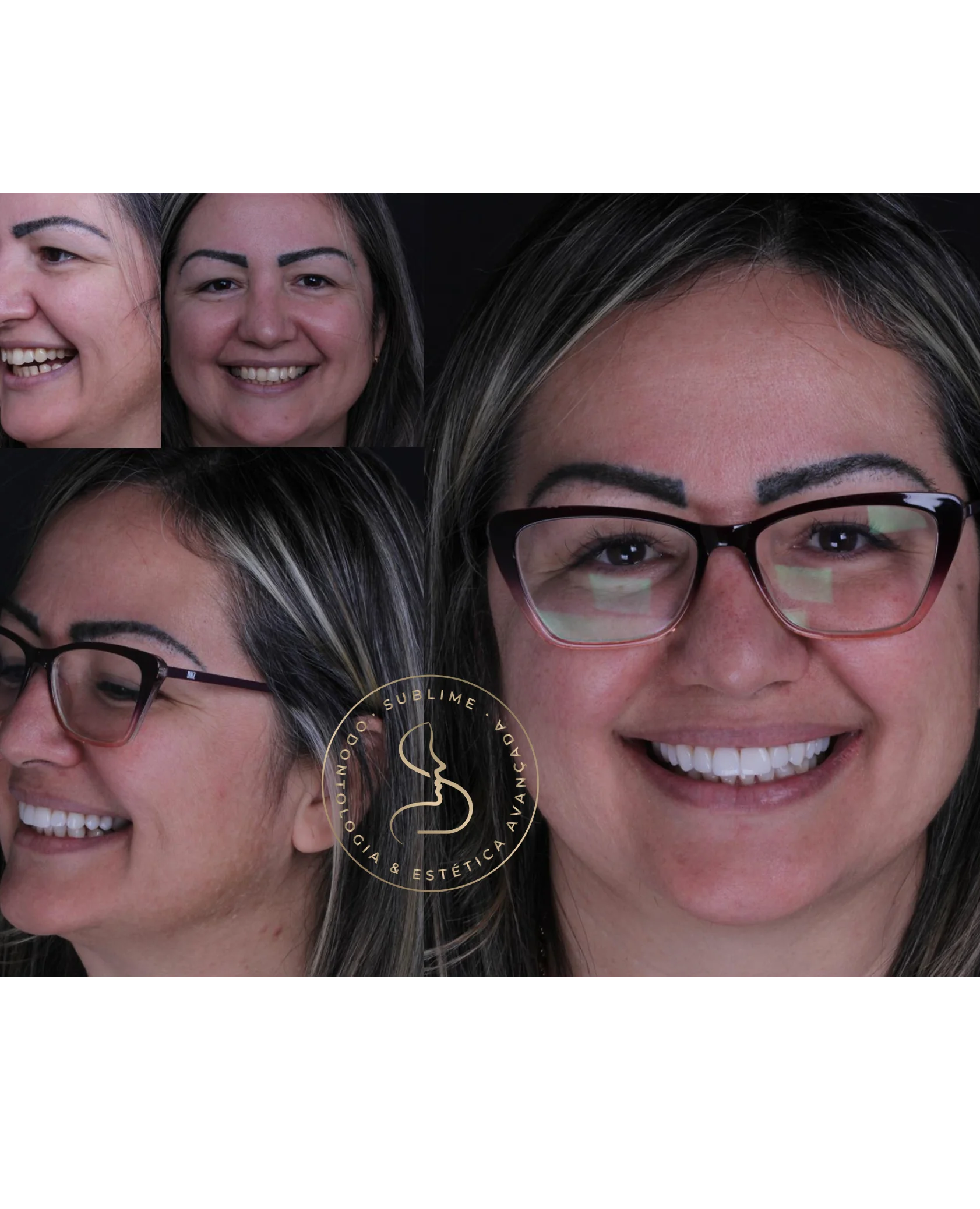 facetasresina4