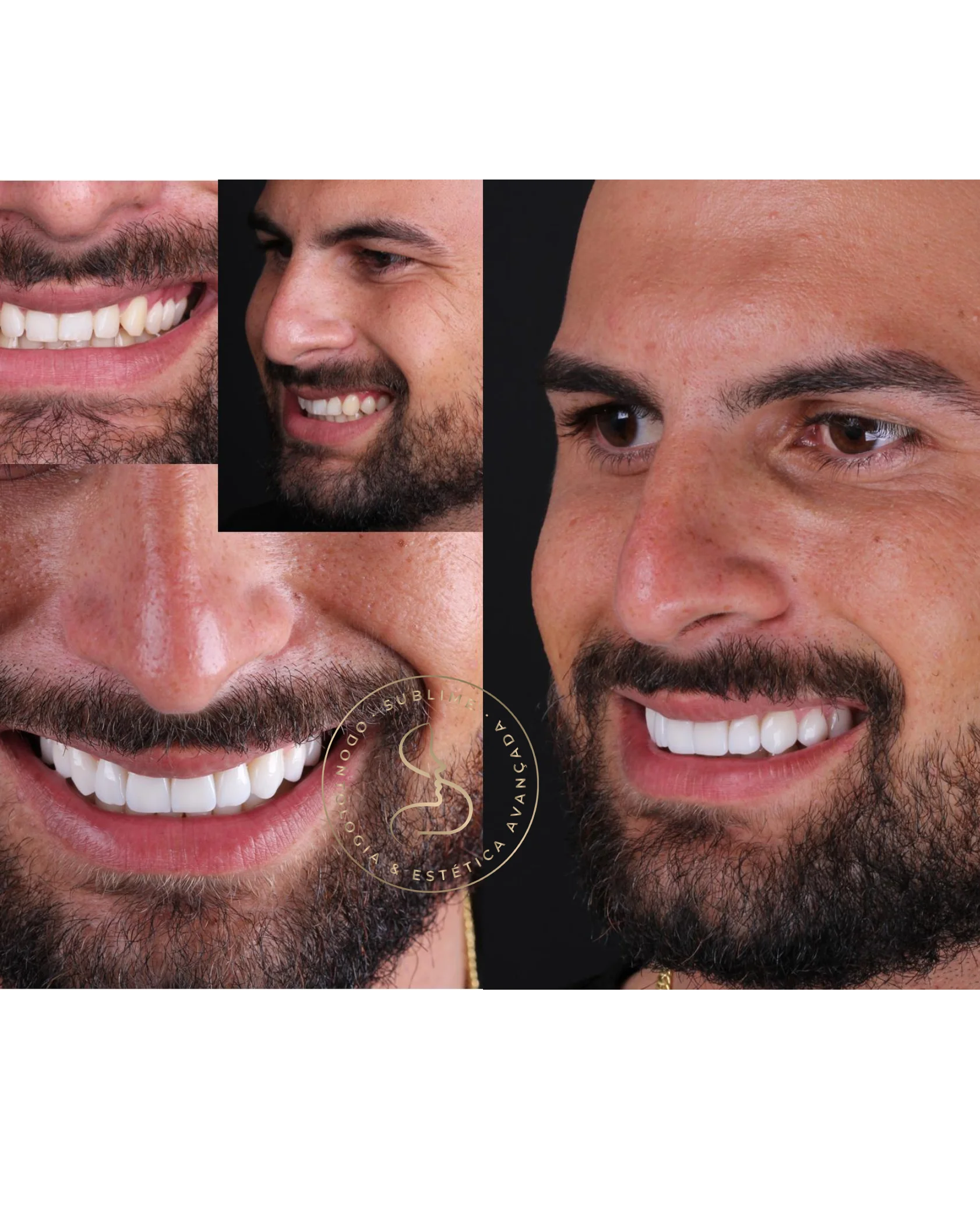 facetasresina5
