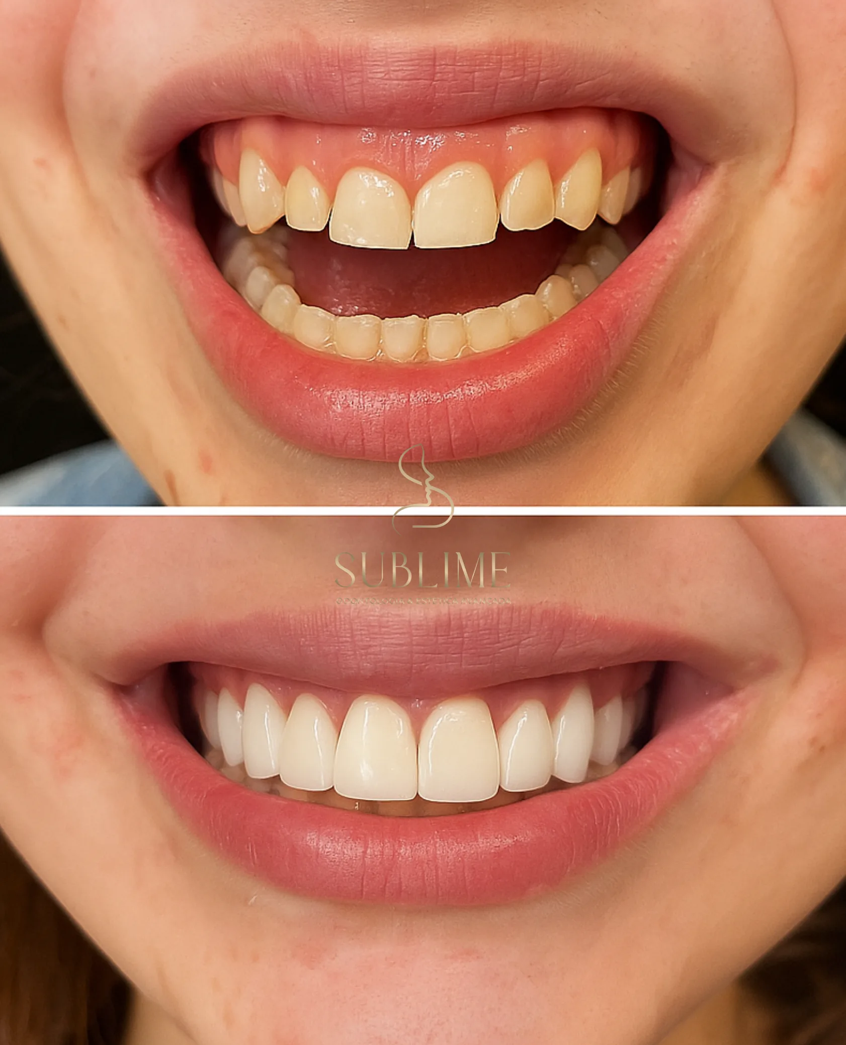 gengivoplastia