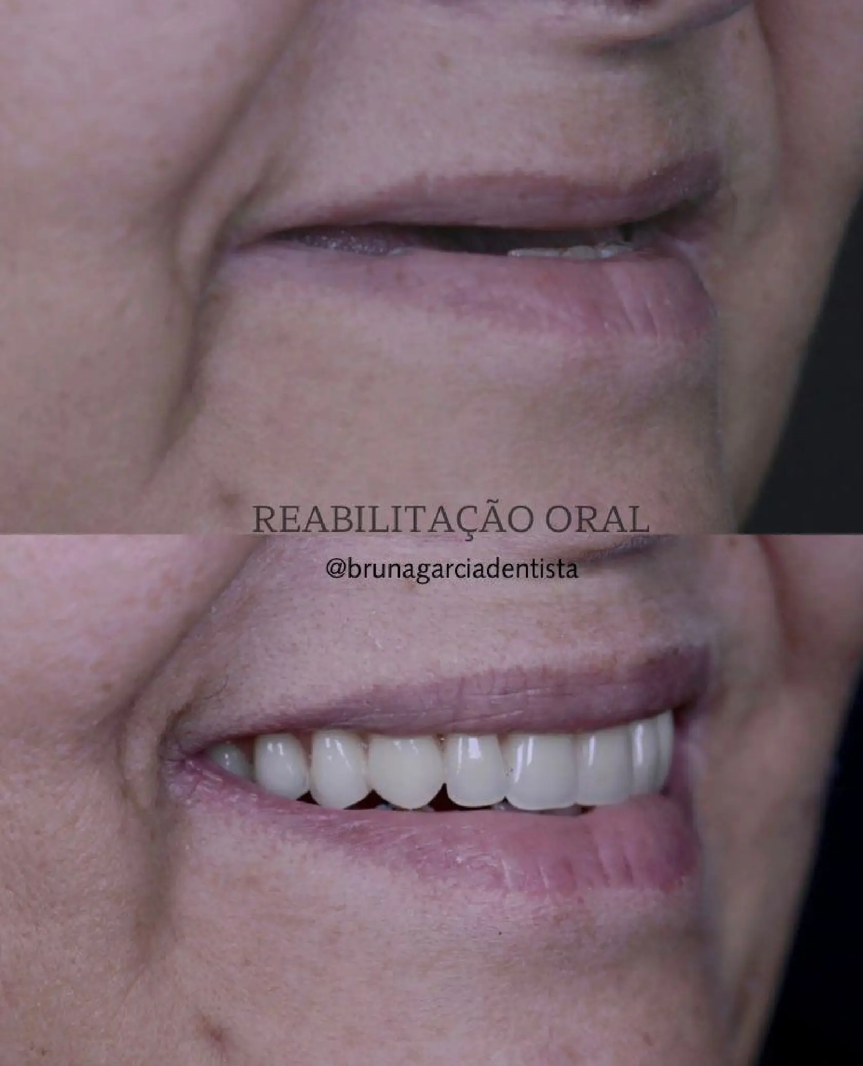 implant-enx3.webp (1)
