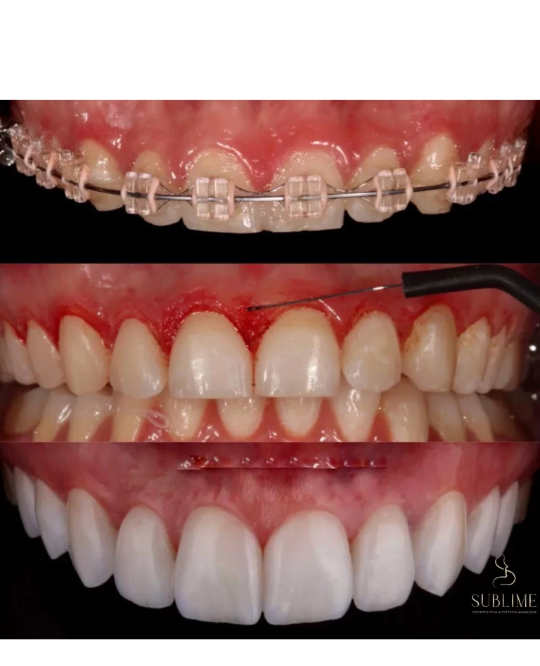 periodental