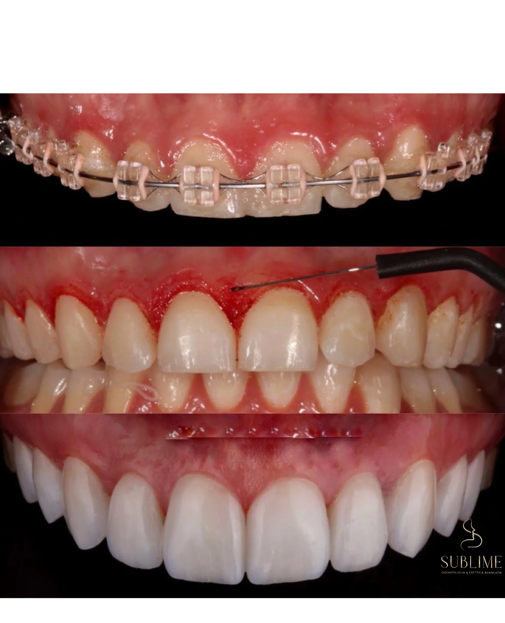 periodental